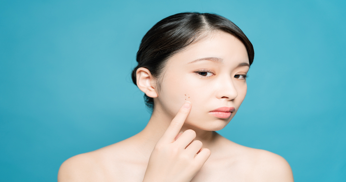 【医師監修】そのホクロは大丈夫？皮膚がんとの見分け方から除去治療まで徹底解説