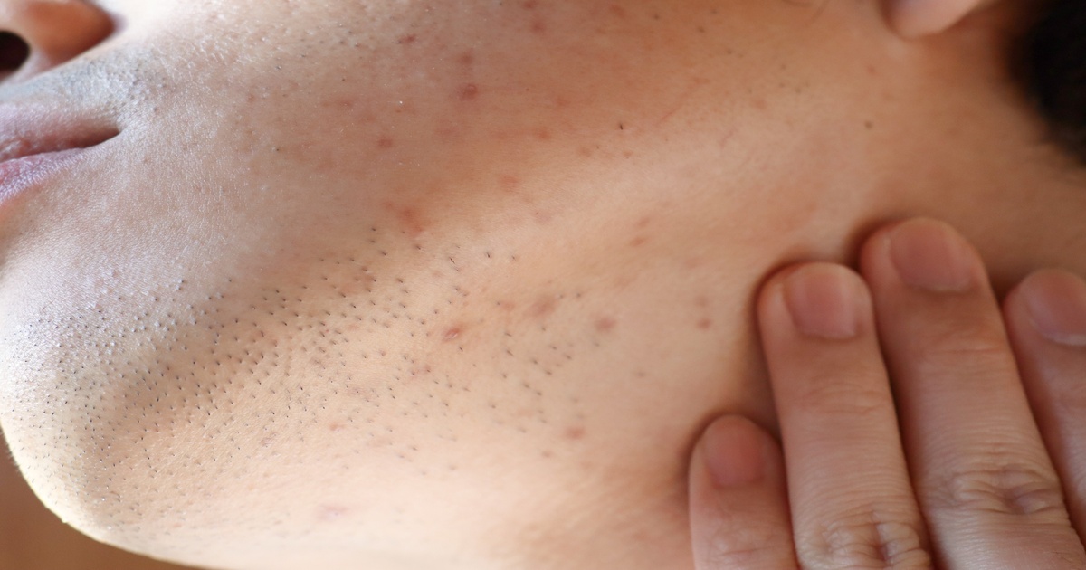 フラクセルレーザーとは？肌悩みを根本から改善するメカニズム