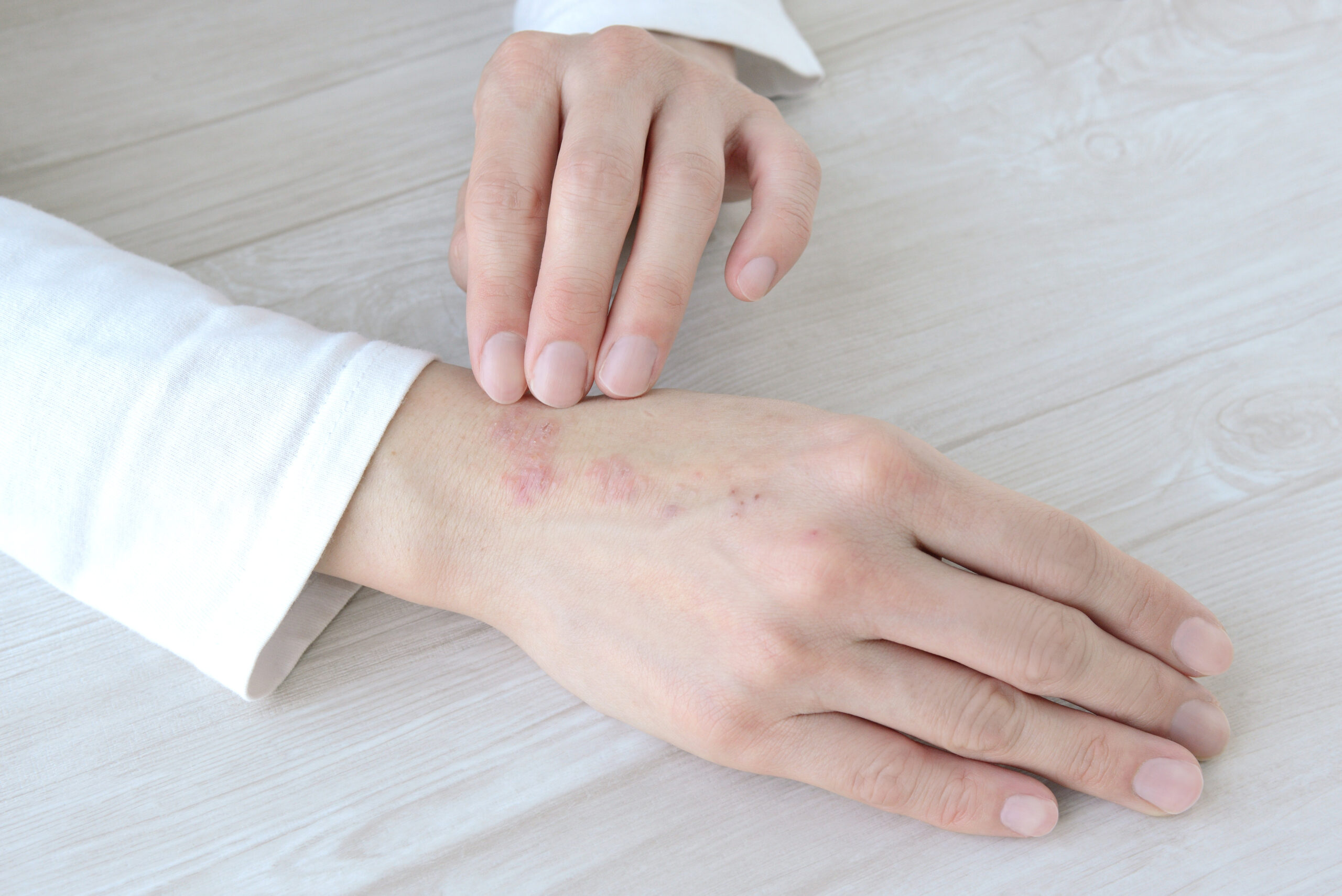 アトピー性皮膚炎の基本的な症状と診断基準