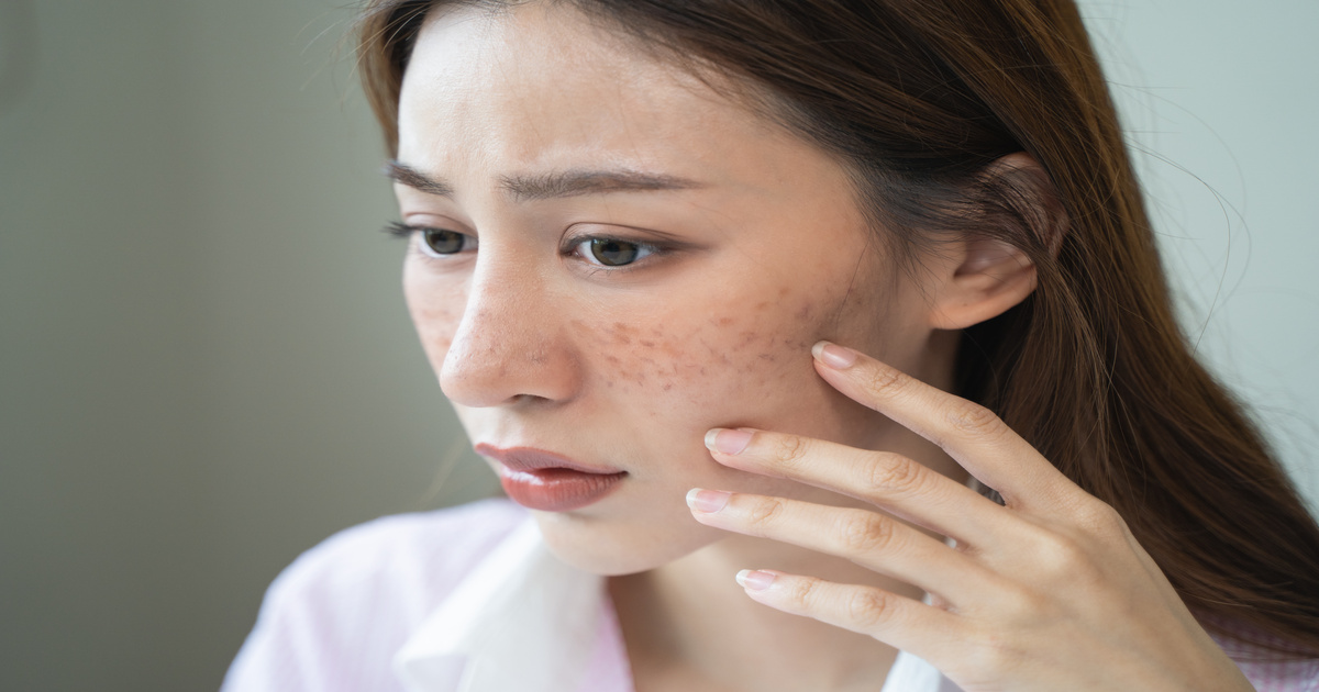 しみの治療と原因を徹底解説！予防法から美容医療まで専門家が教える対策