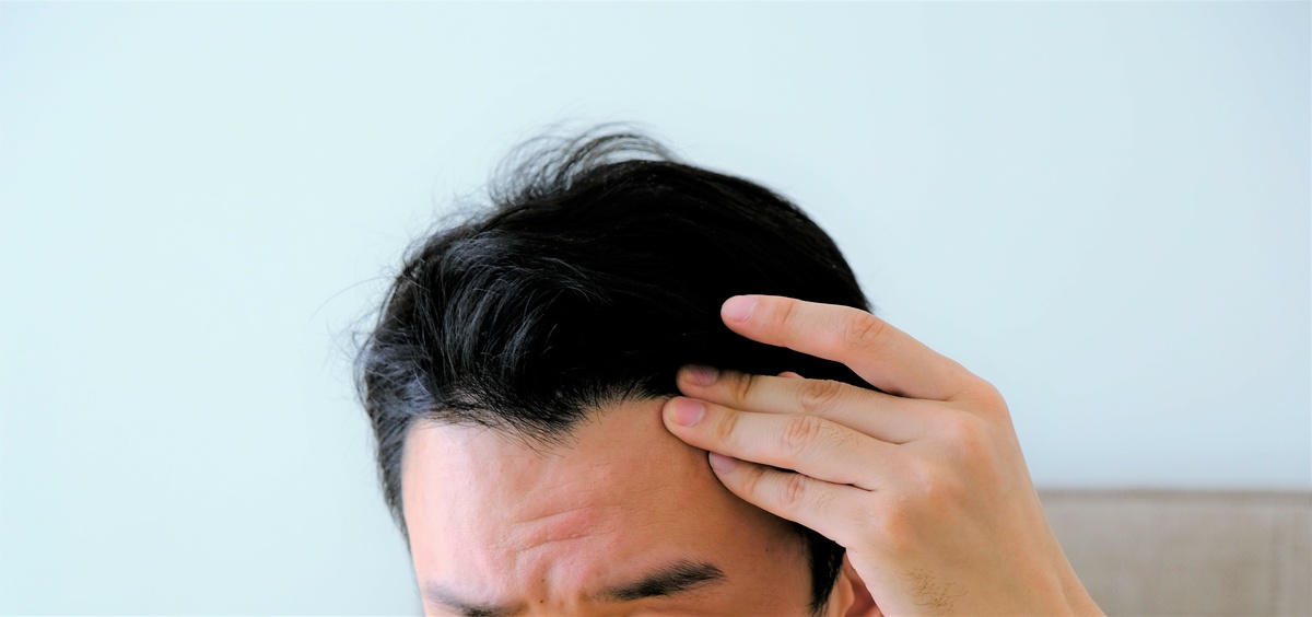 AGA（男性型脱毛症）とは？原因から治療法・自分でできる対策まで専門家が徹底解説